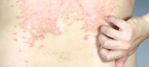 skin texture ill allergic rash dermatitis eczema skin texture